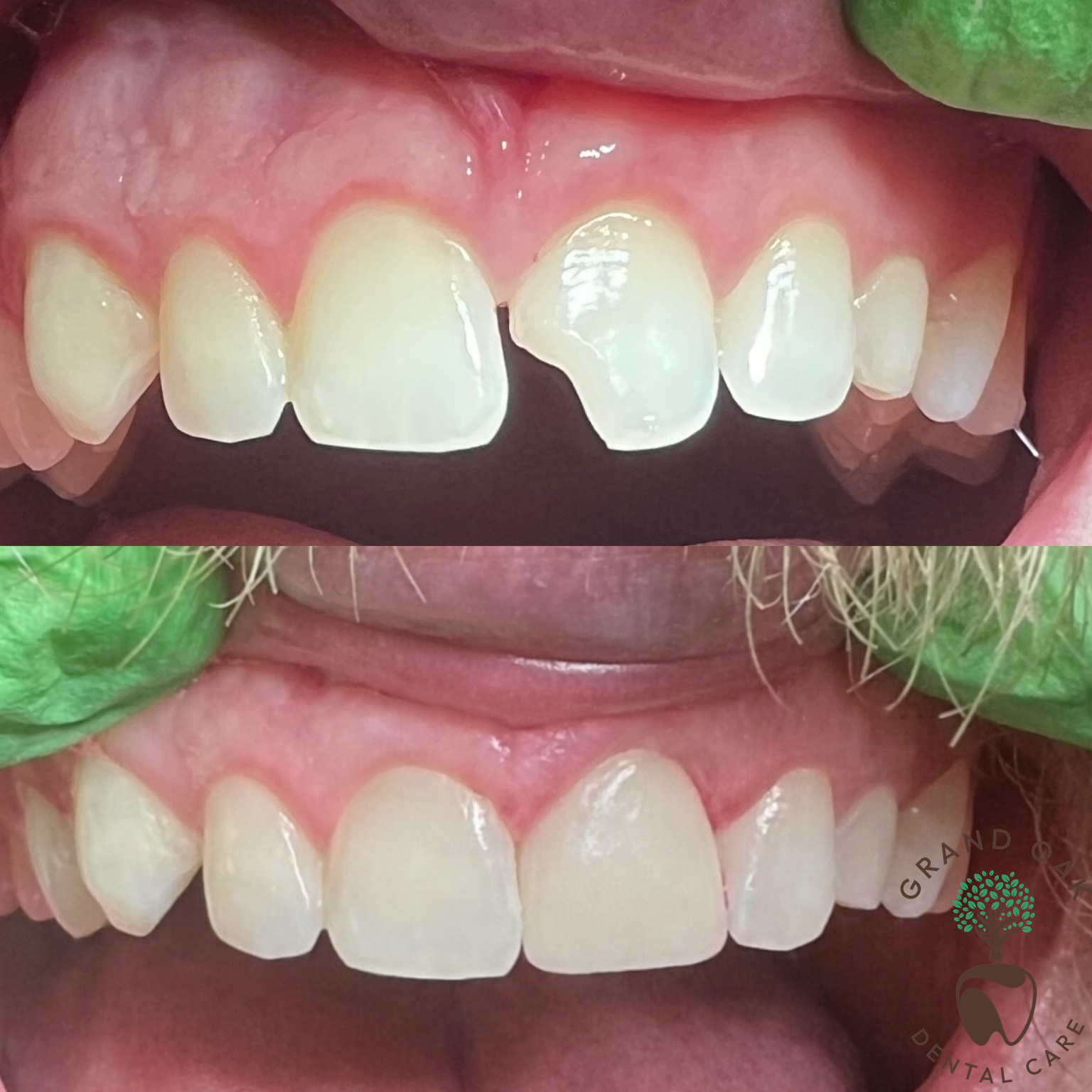Single Veneer, Same Day Delivery